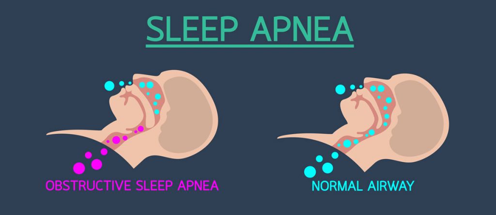 Symptoms of Sleep Apnoea